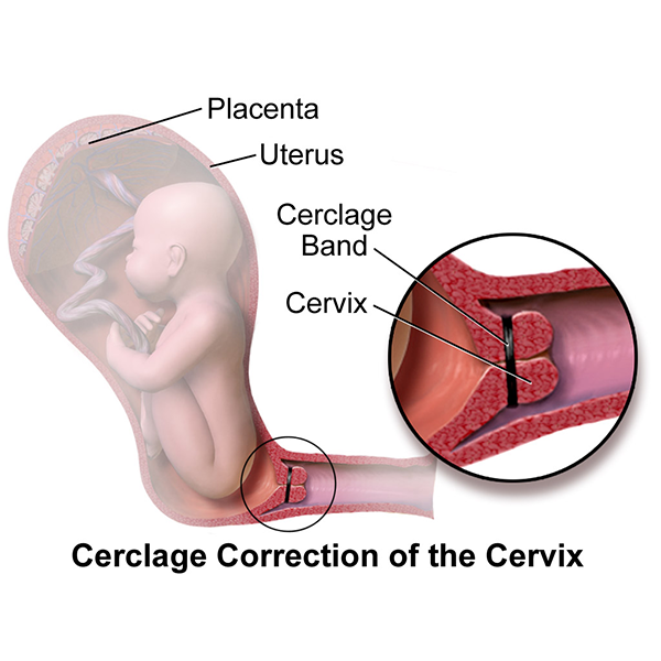 sex after a cervical cerclage